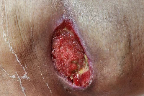 Ferida em membro inferior com leito de granulação, áreas de fibrina e borda macerada
