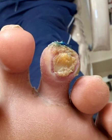 A mesma úlcera com o esfacelo amolecido e o edema do dedo reduzido