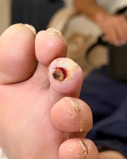Lesão reduzida a uma cratera pequena com crosta escura ao centro